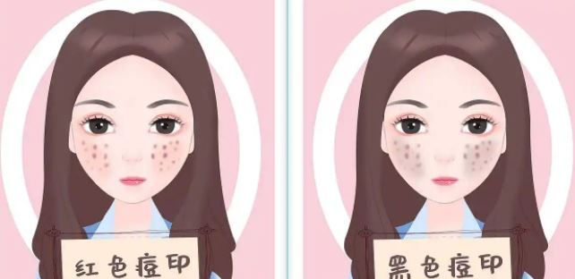 臉上紅色痘印幾個月都不消怎么辦？紅色痘印應(yīng)該怎么消除？