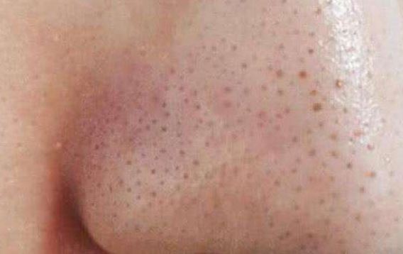 清潔面膜哪個(gè)牌子可以快速祛黑頭？趙薇、薇婭 推薦的紐西之謎泥膜真的好用嗎？